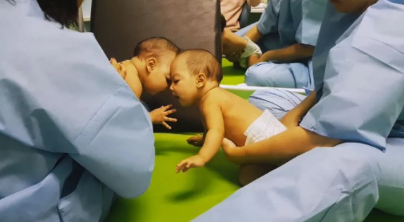  Gêmeas que nasceram grudadas têm vida normal após dois anos da separação