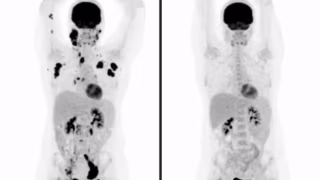 Estudo revela que terapia de R$ 3 milhões oferece melhor custo-benefício no tratamento do câncer