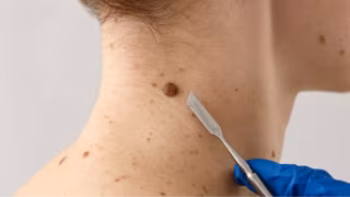 IA identifica melanoma com 94,5% de precisão usando fusão de dados