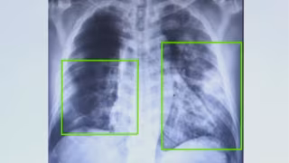 Casos de pneumonia sobem 20% em SP, e vacina gratuita pelo SUS tenta conter formas graves