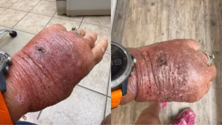 Corte com papelão infecciona e leva mulher ao hospital; foto viraliza