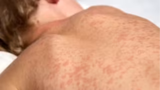 OMS alerta para ressurgimento do sarampo apesar de queda de 71% nos casos globais