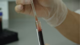 Paciente com HIV fica seis anos sem sinais do vírus após transplante de células-tronco