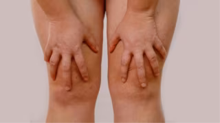 Estudo brasileiro define critérios inéditos em imagem para diagnóstico de lipedema