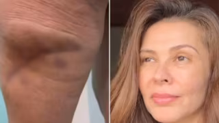 Modelo desenvolve necrose após procedimento estético irregular com caneta pressurizada em SC