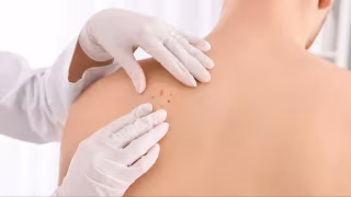 Mutirão nacional oferece avaliação gratuita de câncer de pele neste sábado