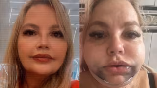 Dentista é denunciada após advogada ficar 12 dias no CTI e ter rosto deformado em lipo de papada no Rio