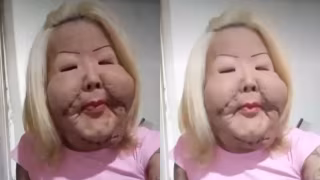 ‘Juju do Pix’ enfrenta complicações após cirurgia para retirar óleo mineral do rosto