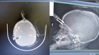Bebê de 1 ano passa por cirurgia após ter carregador cravado na testa em Divinópolis