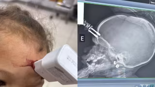 Bebê que teve carregador cravado na testa recebe alta, mas seguirá em acompanhamento neurológico