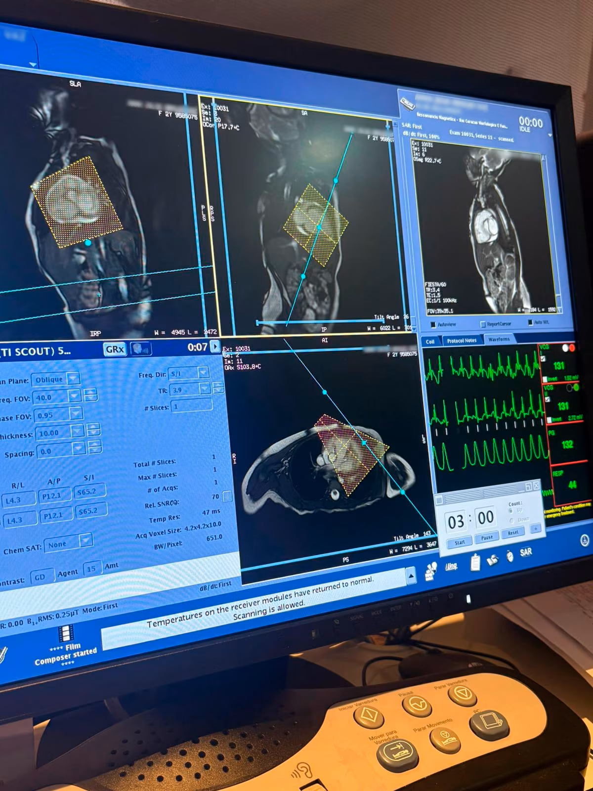 Release - Hospital Márcio Cunha realiza a primeira ressonância cardíaca pediátrica do Vale do Aço