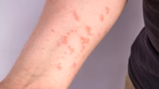 Porto Alegre confirma novo caso importado de Mpox e reforça orientações antes do Carnaval