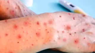 MG confirma 3 casos de mpox em 2026; pacientes são homens e evoluíram para cura