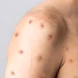 Brasil soma 88 casos confirmados de mpox em 2026, aponta Ministério da Saúde