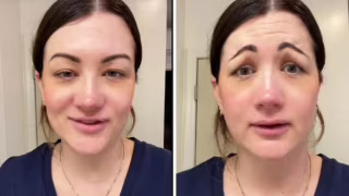 Erro na aplicação de botox deixa britânica com assimetria facial e ‘cara de palhaço triste’