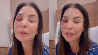 Ivete Sangalo fala sobre queda em Salvador, fraturas no rosto e cirurgia em São Paulo