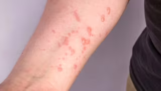 Casos de mpox no Brasil em 2026 chegam a 140, mas números divergem em atualizações oficiais