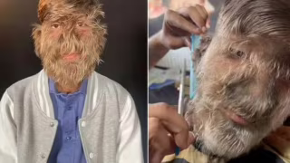 “Síndrome de lobisomem”: jovem com hipertricose vira influencer ao mostrar rotina com excesso de pelos