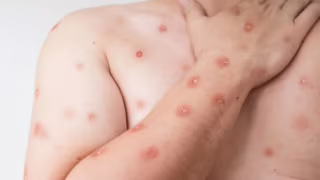 Sobe para 13 o número de casos de mpox em Minas? Informação volta a circular, mas ainda não aparece em balanços oficiais