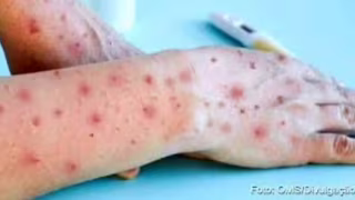 Manhuaçu confirma primeiro caso de mpox em 2026, diz SES-MG