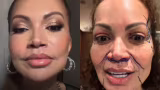 Solange Almeida mostra antes e depois de lifting facial e diz estar satisfeita com resultado