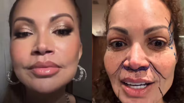 Solange Almeida mostra antes e depois de lifting facial e diz estar satisfeita com resultado