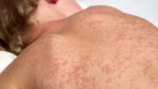 SES-RJ confirma caso de sarampo no Rio e prefeitura reforça vacinação em áreas de grande circulação