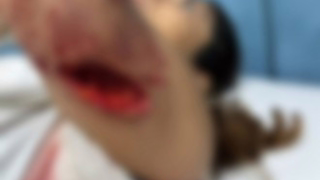 Terapeuta ocupacional é atacada por cão e leva oito pontos no braço em MG