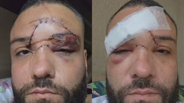 Polícia Civil do RJ investiga agressão a designer em bar de Mesquita; vítima aponta homofobia