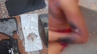 Celular explode na mão de menino de 6 anos e criança sofre queimaduras