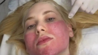 Virginia Fonseca mostra marcas no rosto após laser e relata ardência no pós