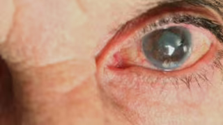 SUS vai oferecer cirurgia que trata catarata e glaucoma ao mesmo tempo a partir de 2027