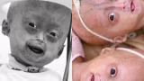 Morre Elis Lima Carneiro, menina de 5 anos diagnosticada com progéria, em Boa Vista