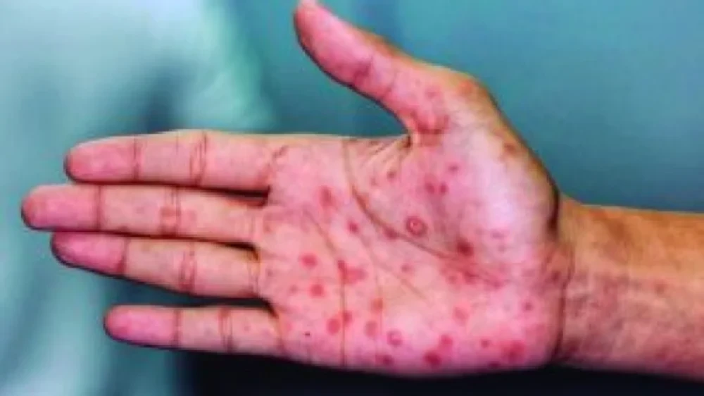 BH supera 4 mil casos de sífilis e alerta para avanço da doença