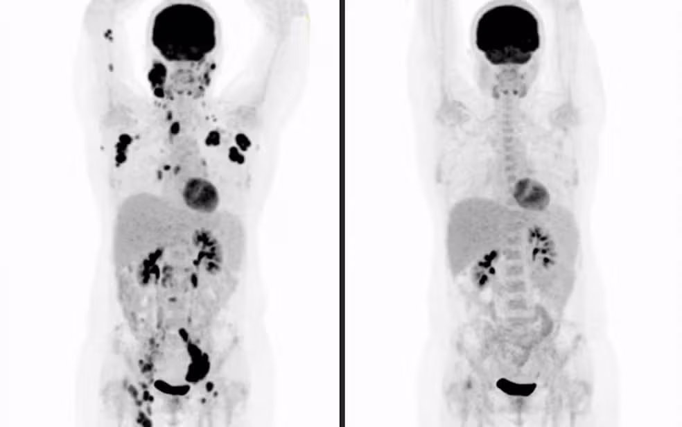 Pesquisa indica que tratamento de R$ 3 milhões apresenta superior custo-benefício na luta contra o câncer