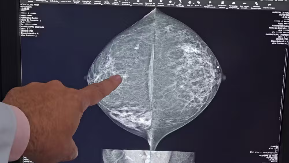 Mamografia de paciente com neoplasia de pequeno porte na mama Hospital de Amor Barretos