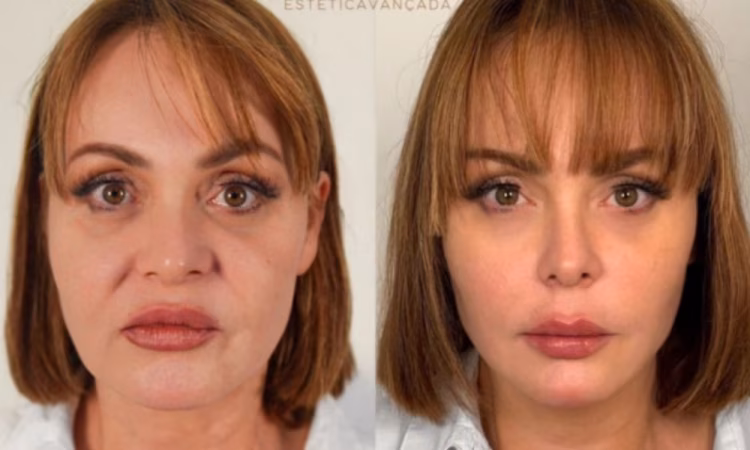 A atriz divulgou em suas redes sociais os resultados dos tratamentos realizados