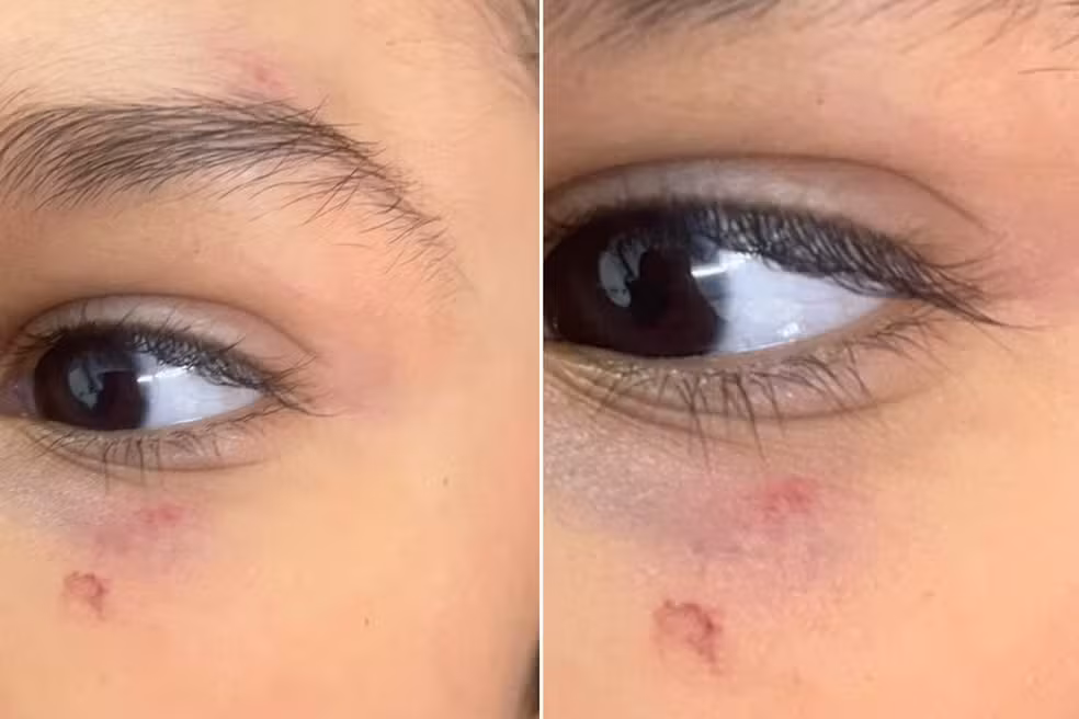 Na segunda-feira (17), Cristiane falou com a diretora e foi informada de que a professora afirmou que o menino corria pela sala quando teria batido o rosto na lousa