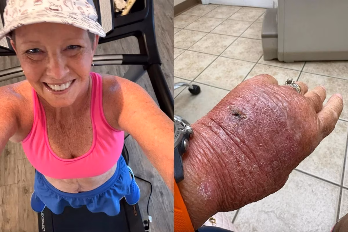 Um pequeno corte acabou se transformando em uma infecção que surpreendeu a norte-americana Melinda Howard, de 63 anos, e o caso viralizou no X