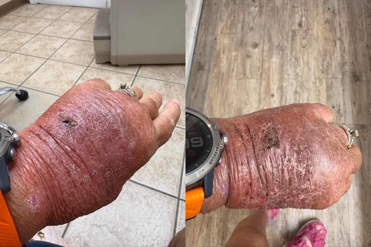 Mulher de 63 anos é hospitalizada após infecção causada por corte com papelão