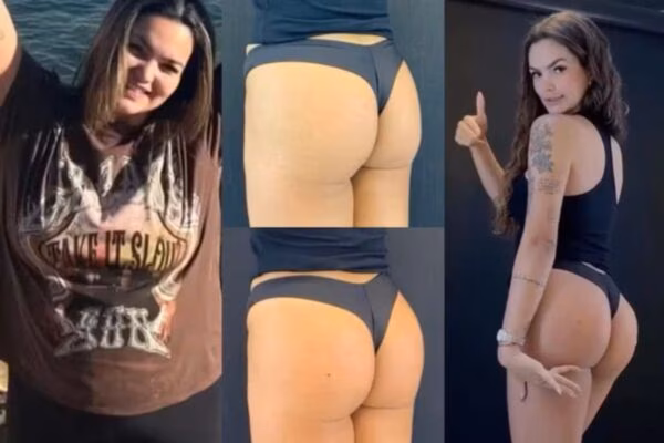 A união das duas técnicas pretende oferecer um resultado mais abrangente, melhorando tanto o contorno quanto a qualidade da pele do bumbum