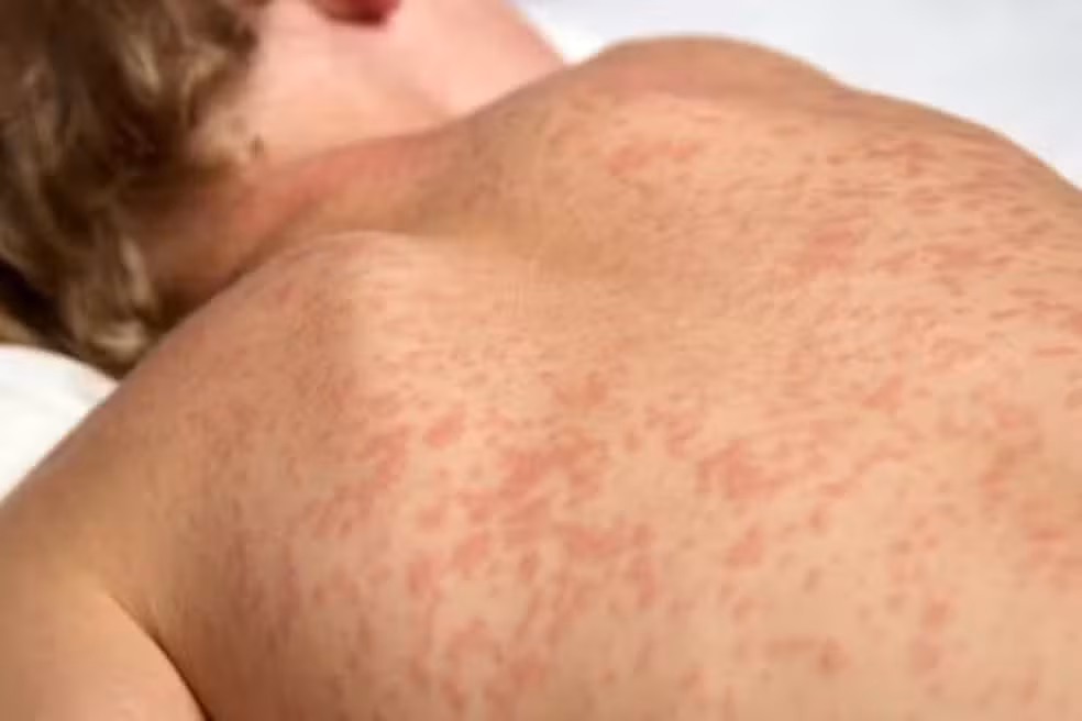 Diante do surto de sarampo na Bolívia, Mato Grosso do Sul adiantou a aplicação da dose zero em bebês