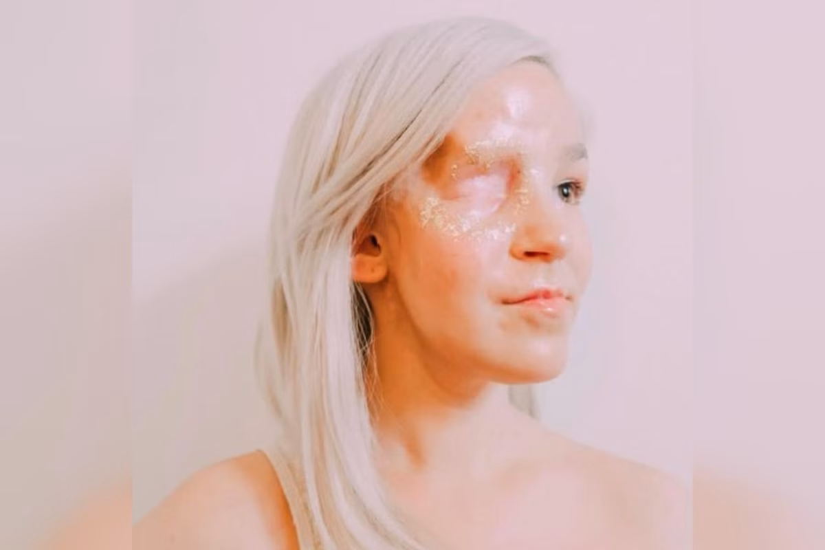 Melanie hoje, depois de ter o olho direito removido em razão de um câncer ocular raro