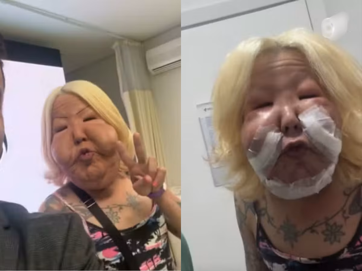 A influenciadora teve óleo mineral aplicado no rosto em uma operação, em 2017.