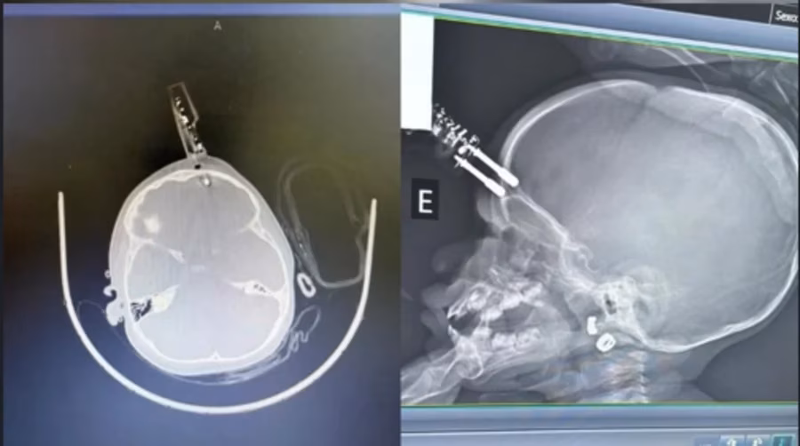 O acidente ocorreu quando a mãe da criança saiu do quarto e foi ao banheiro