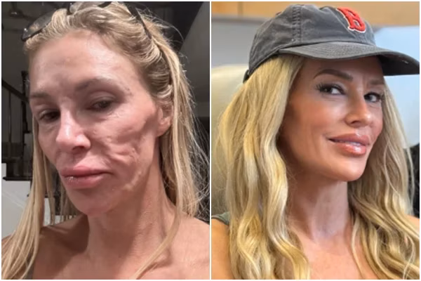 Brandi Glanville convive com uma doença que está se agravando e fazendo o rosto dela “derreter”