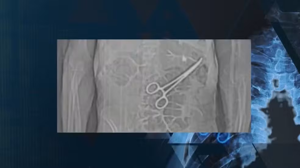 Veja casos de itens esquecidos dentro do corpo de pacientes no Brasil