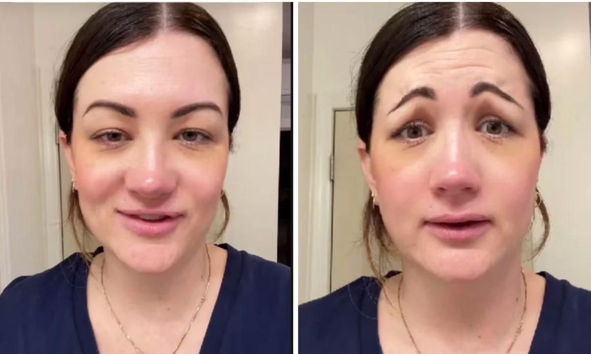 Aplicação de botox com erro deixou mulher com aparência de palhaço triste
