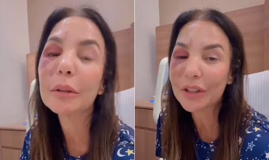 Ivete Sangalo faz live após cirurgia