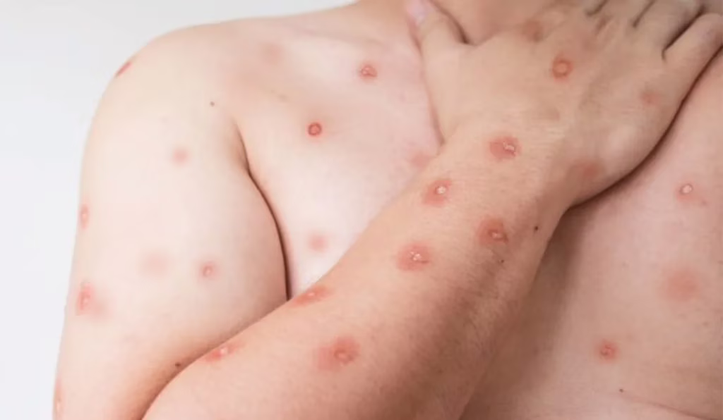 Doença mpox.